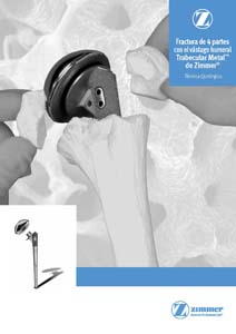 Trabecular Metal™ de Zimmer® Fractura de 4 partes con el vástago humeral